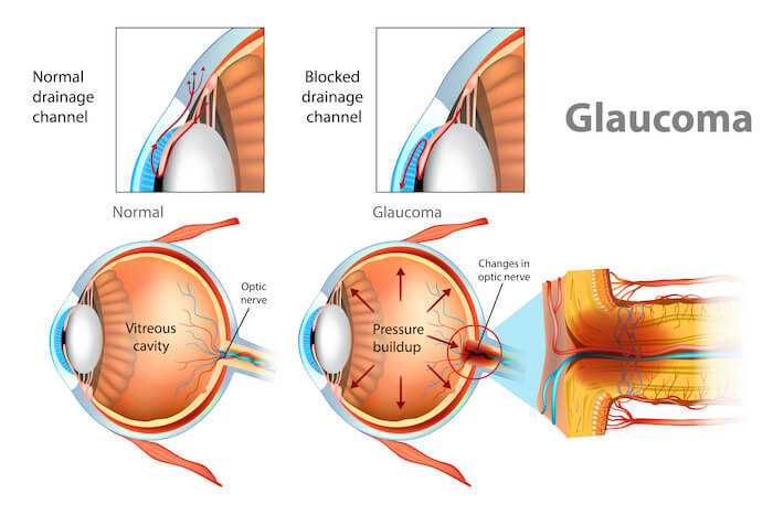 Illustration of normal eye and eye with glaucoma